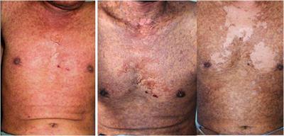 Allopurinol-Induced Stevens–Johnson Syndrome in Javanese Men With Positive HLA‐B*58:01